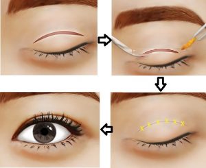 Quá trình cắt mí mắt tại Soeul Center