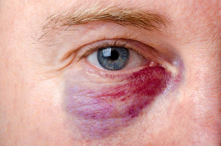 Máu bầm ở mí mắt thường được gặp nhất trong các tổn thương về mắt