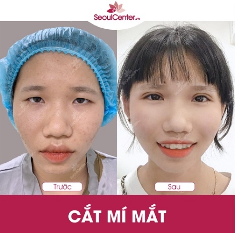 Kết quả trước và sau khi cắt mí mắt tại SeoulCenter.Vn