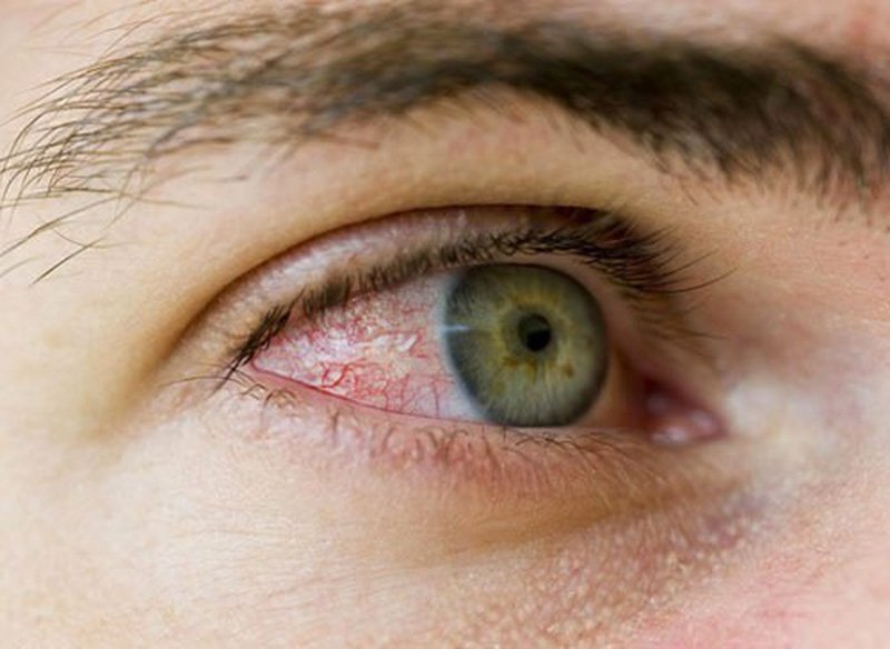 Nếu không giữ mí mắt cẩn thận rất dễ bị nhiễm trùng mí mắt